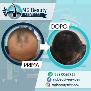 MG BEAUTY SERVICE Trapianto di capelli Follicular Unit Extraction e la Direct Hair Implant per il miglior risultato