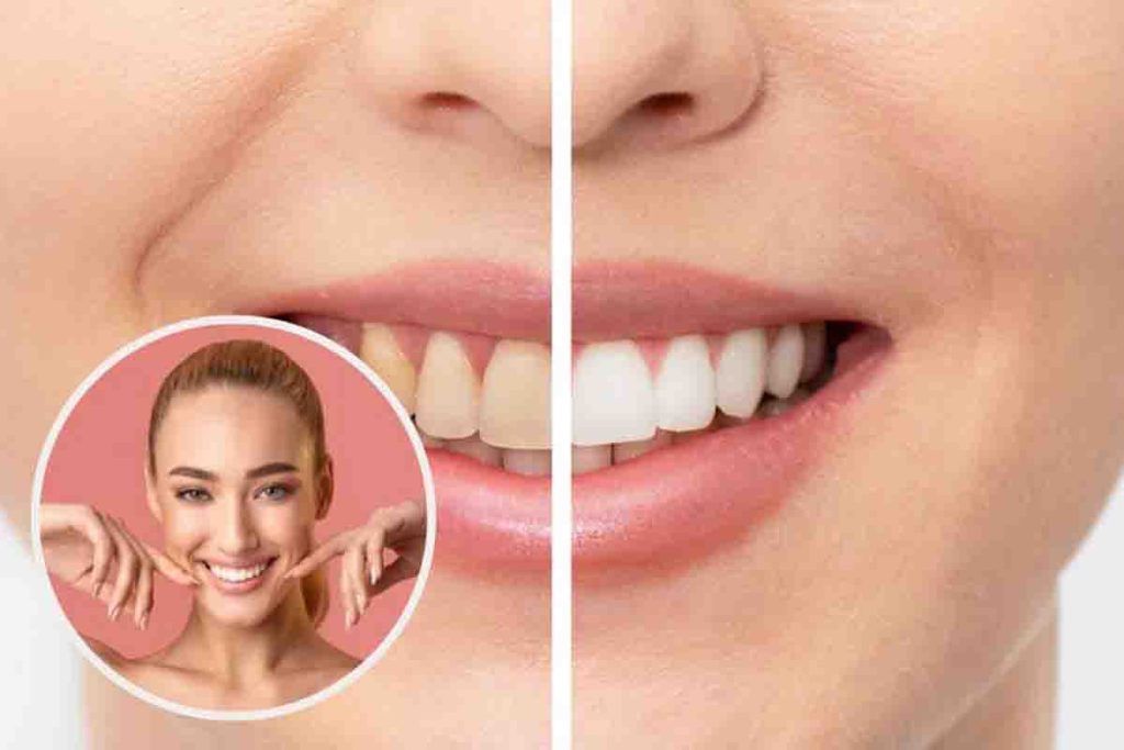 come avere denti bianchi