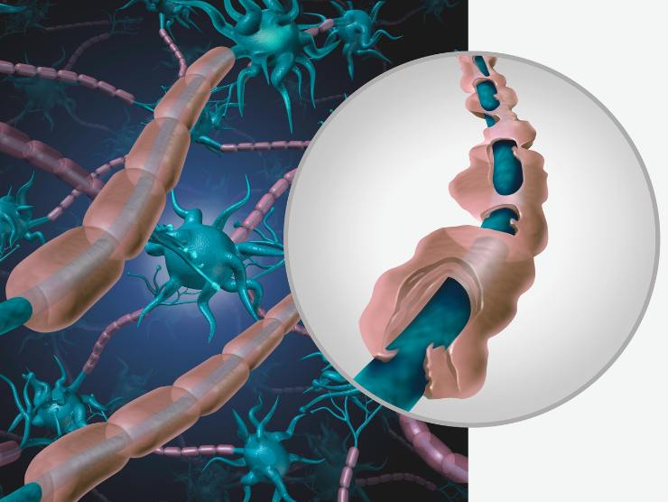 Problemi di formicolio, può essere una patologia molto seria