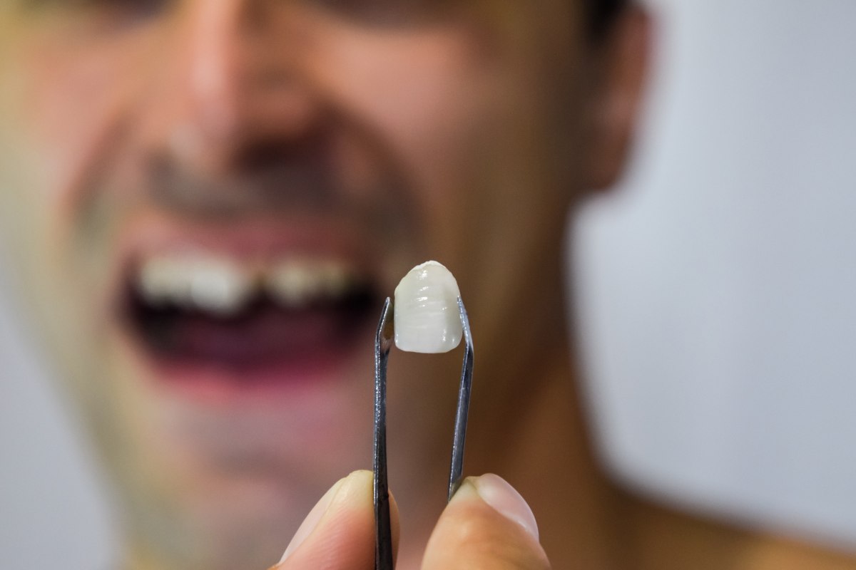 Uomo che mostra il dente caduto