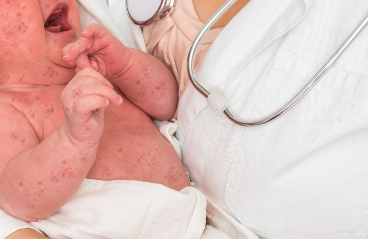 Neonato col morbillo