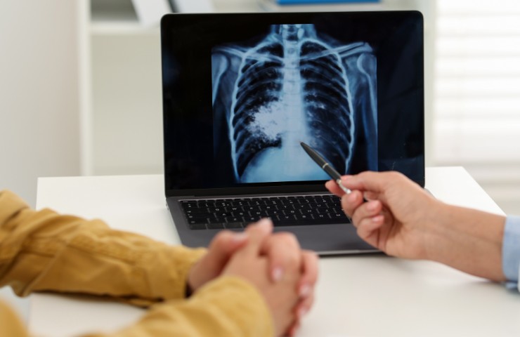 Diagnosi di tumore ai polmoni