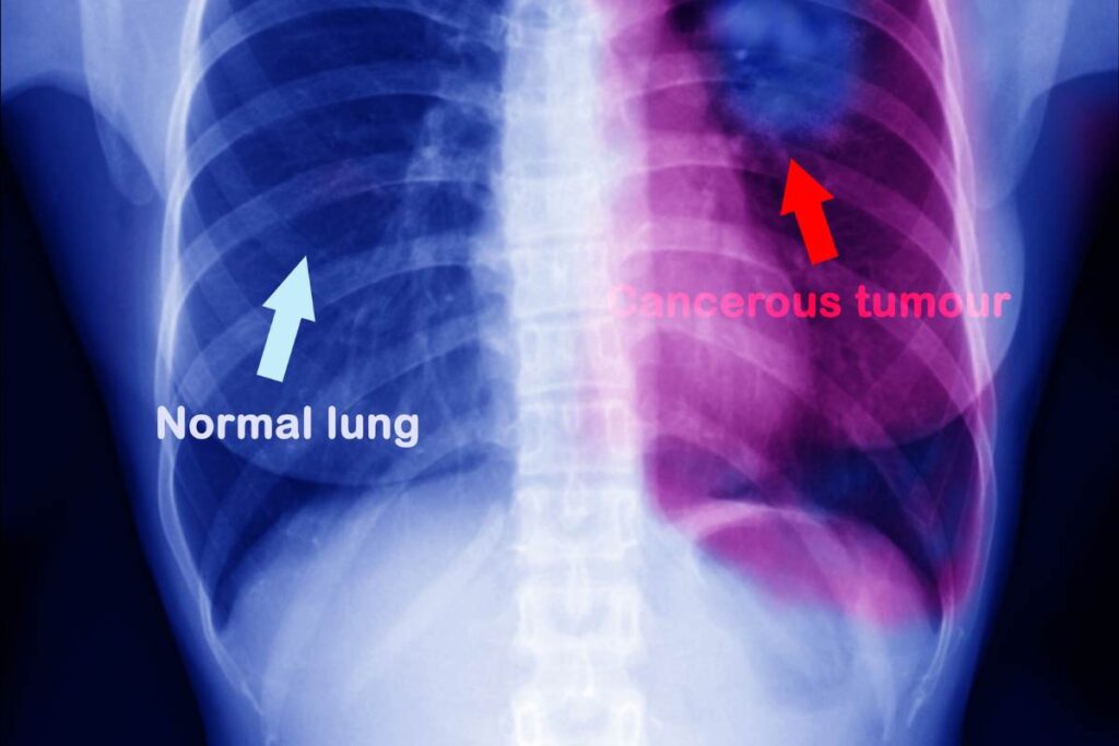 Schema di tumore al polmone