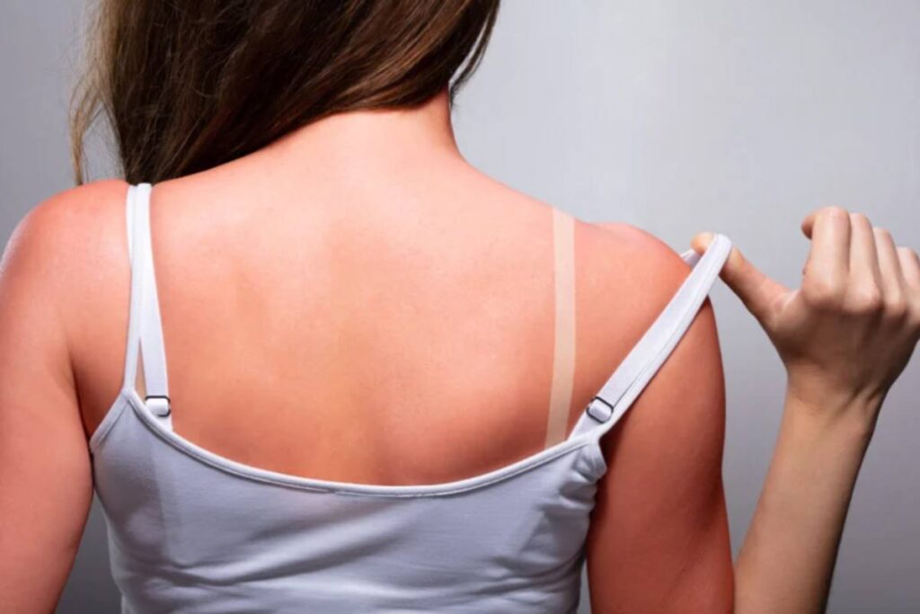 donna con la schiena arrossata dal sole